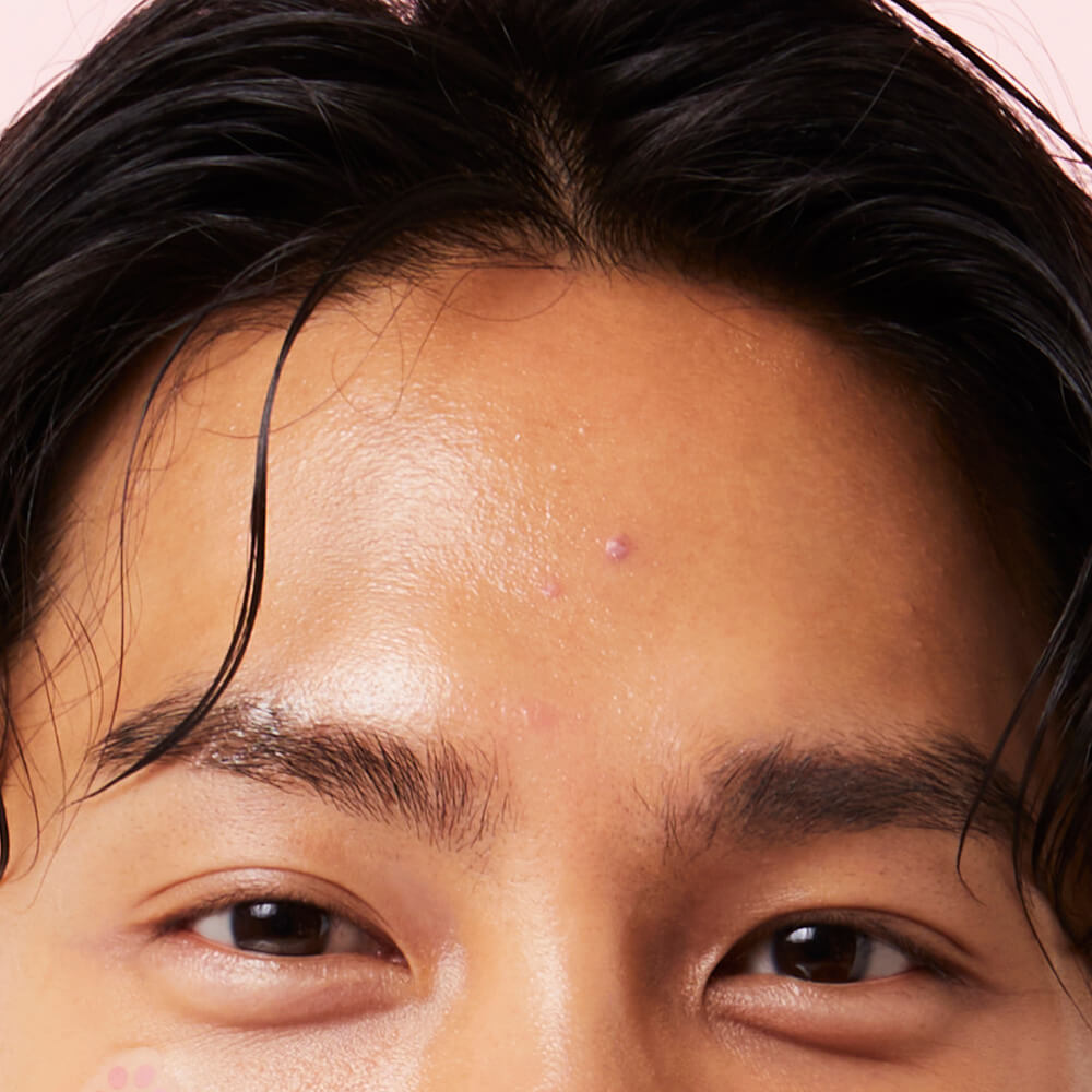 best acne patch - facial blemish stickers